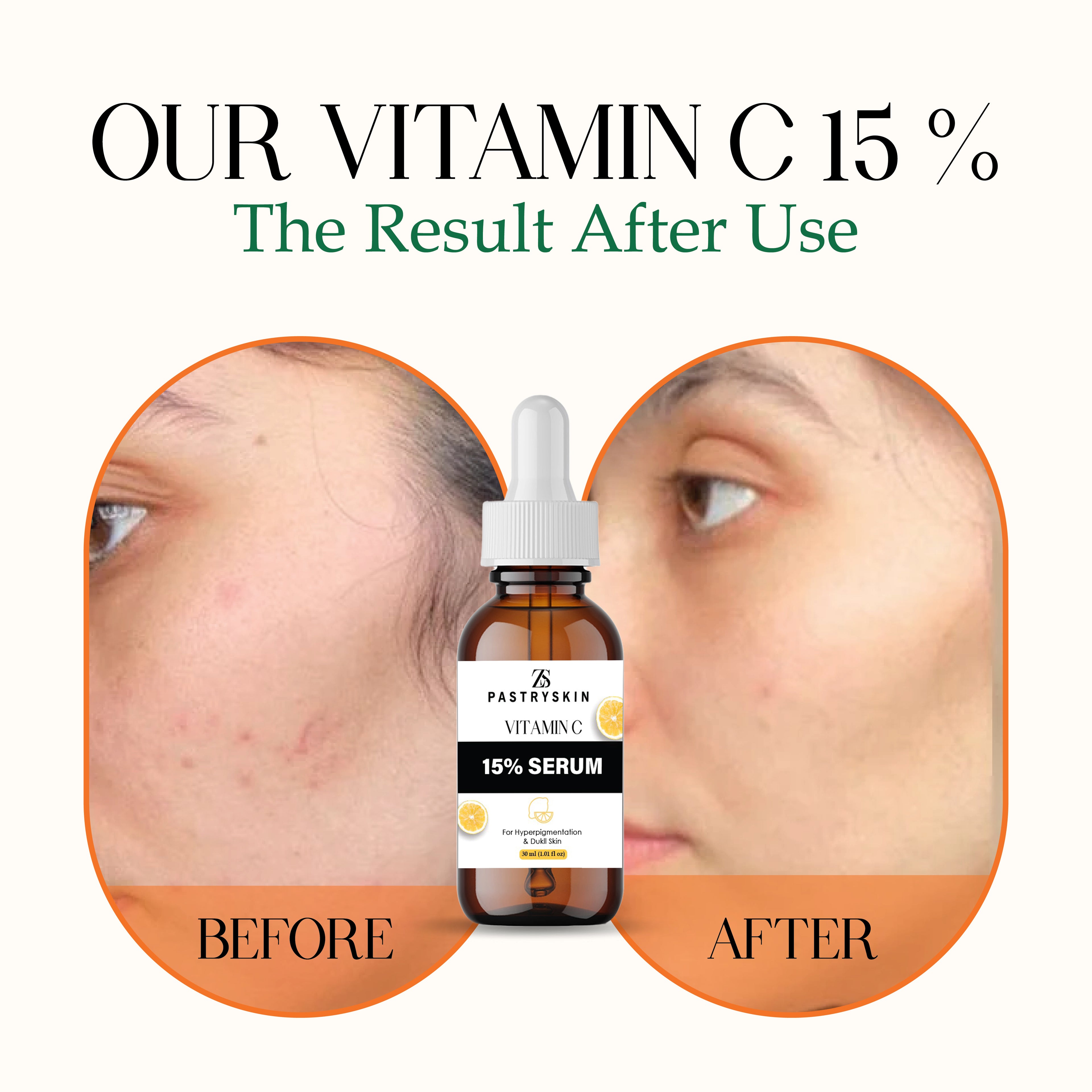 ZS PastrySkin - Vitamin C 15% Serum For Hyperpigmentation & Dukll Skin Advanced Brightening & Anti-Aging Formula | Unisex Skincare for Radiant Glow