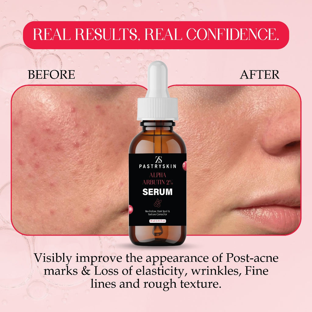 ZS PastrySkin - Alpha Arbutin 2% Serum – Brightening & Advanced Dark Spot Corrector  Even Skin Tone, Unisex Skincare